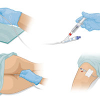 Rectal Delivery System