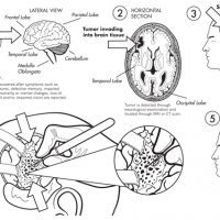med_BrainSurg med_BrainSurg
