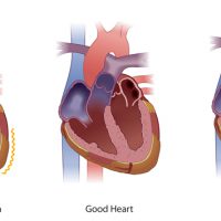 med_HeartIn med_HeartIn